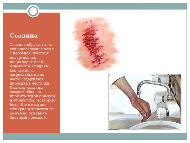 Ссадина Ссадина образуется от соприкосновения кожи с неровной, жёсткой поверхностью, например землёй, асфальтом. Ссадины , как правило, загрязнены, в них часто содержатся инородные частички. Поэтому ссадины следует обильно промыть водой с мылом и обработать раствором йода. Если ссадина обширна и кровоточит, её нужно прикрыть бинтовой повязкой.