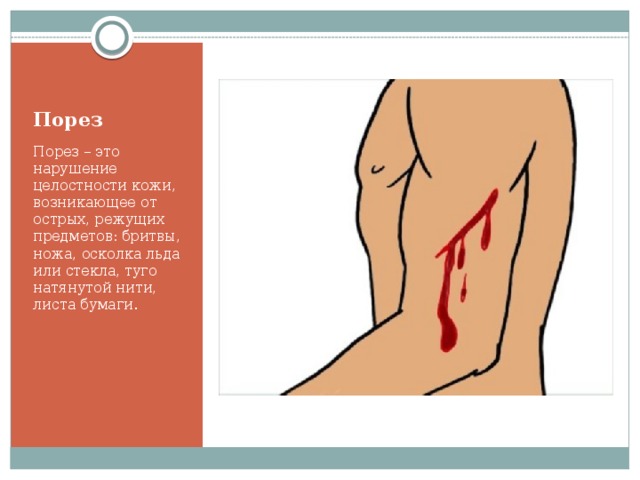 Порез Порез – это нарушение целостности кожи, возникающее от острых, режущих предметов: бритвы, ножа, осколка льда или стекла, туго натянутой нити, листа бумаги.